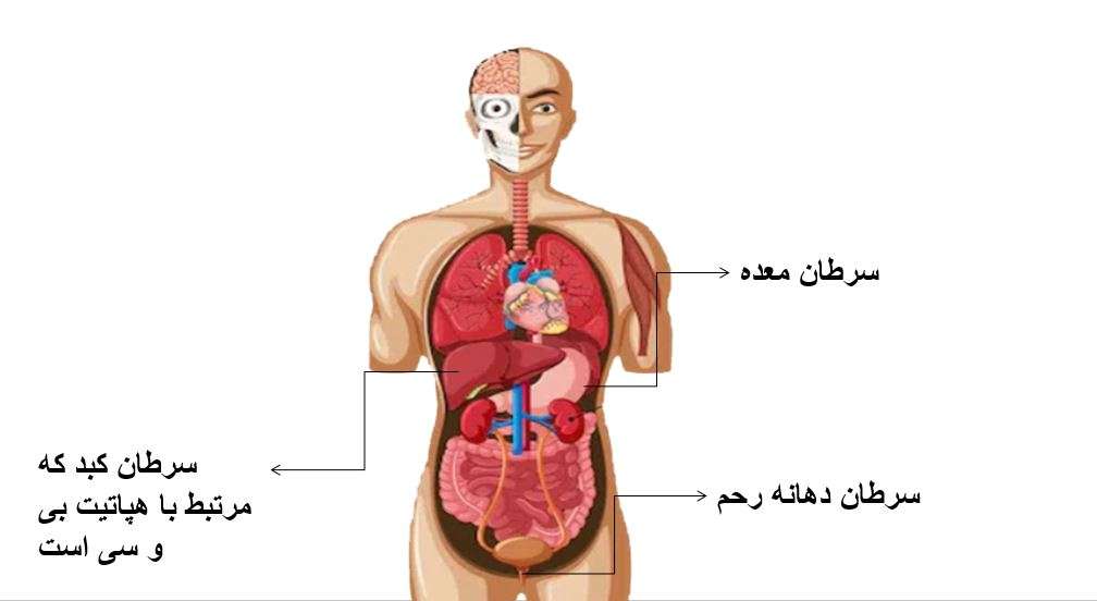 (4) پیشگیری از سرطان؛عفـونت‌ها